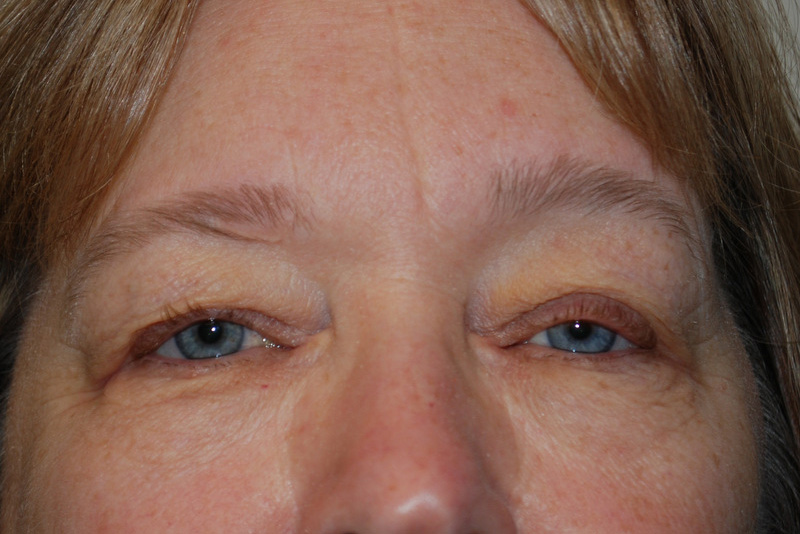 Eyelid-Surgery-06 | Before Eyelid Surgery 1