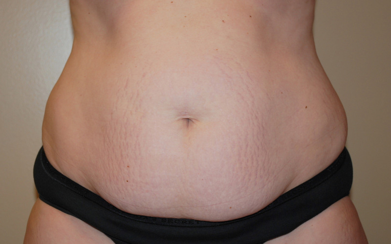 Tummy-Tuck-08 | Before Tummy Tuck