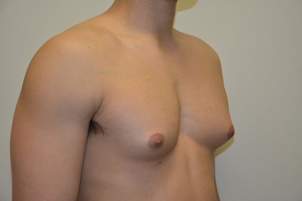 Male-Breast-Reduction-05 | Before Male Breast Reduction 2