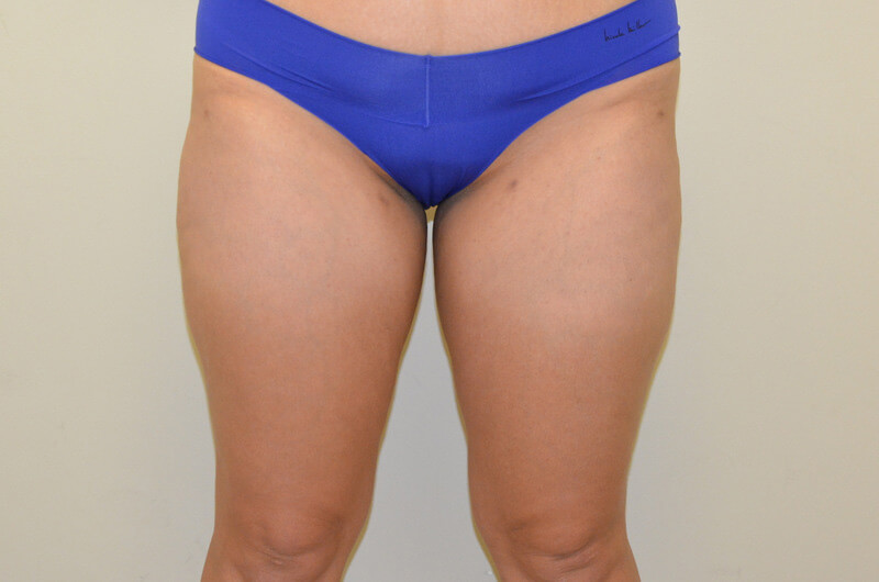 Liposuction-04 | After Liposuction