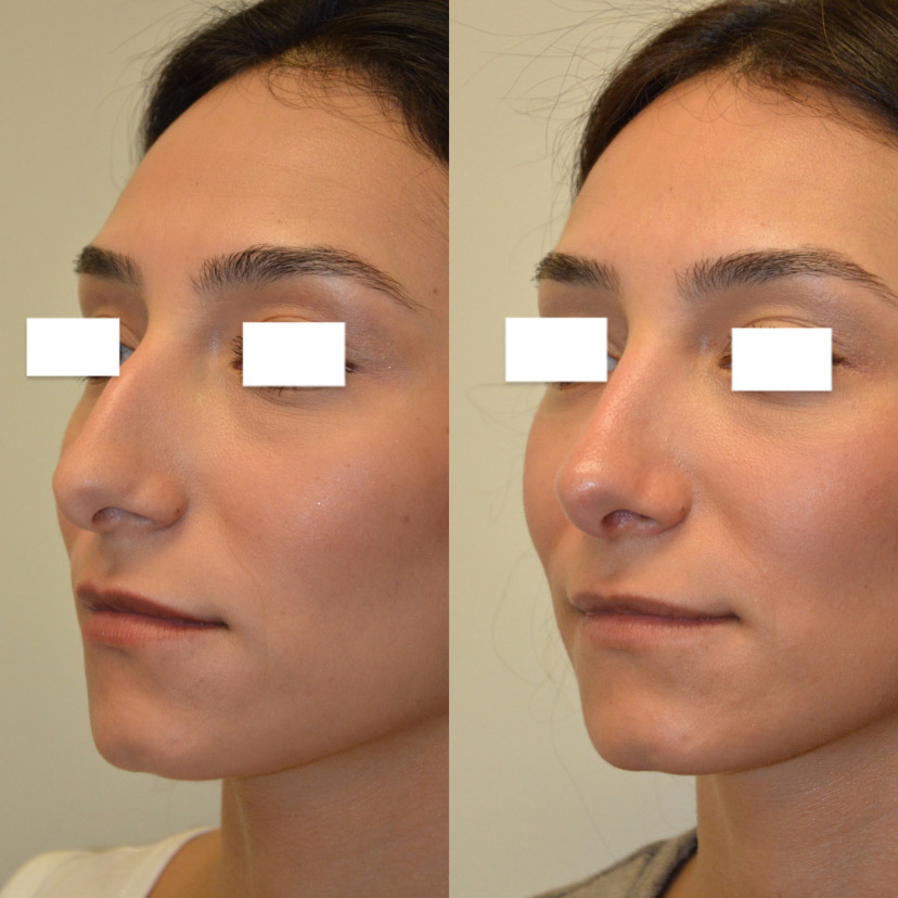Rhinoplasty-05 | Before Rhinoplasty