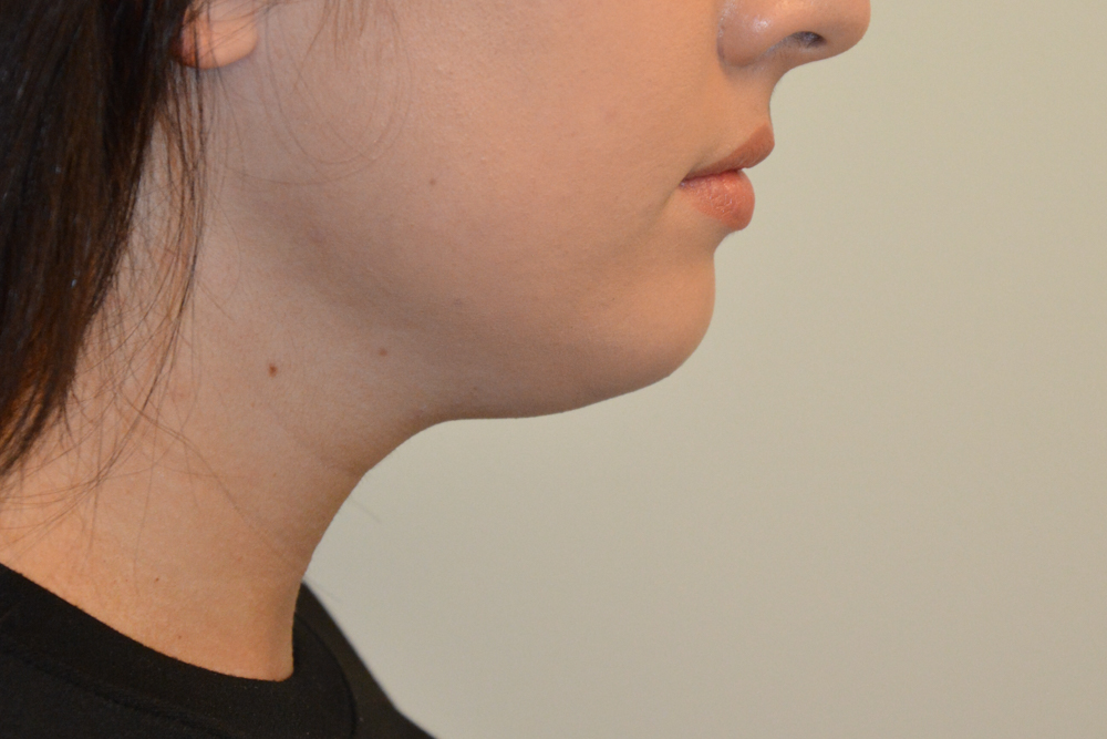 Neck-Liposuction-05 | Before Neck Liposuction 3