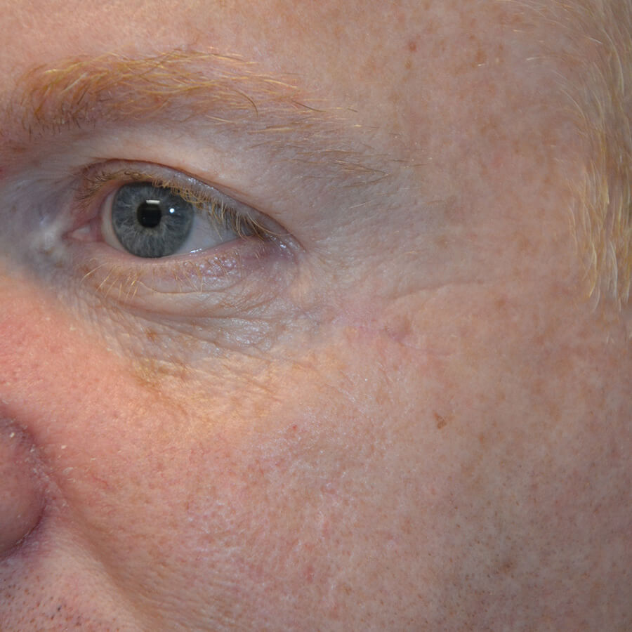 Skin-Cancer-Reconstruction-05 | After Skin Cancer Reconstruction