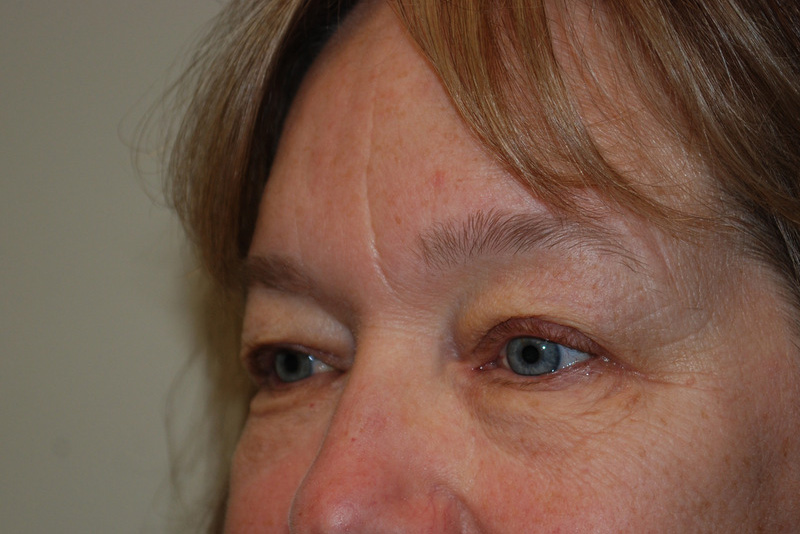 Eyelid-Surgery-06 | Before Eyelid Surgery 2