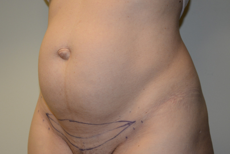 Mini-Tummy-Tuck-05 | Before Mini Tummy Tuck 2
