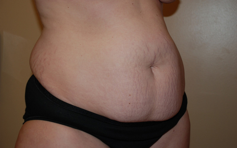 Tummy-Tuck-08 | Before Tummy Tuck 2