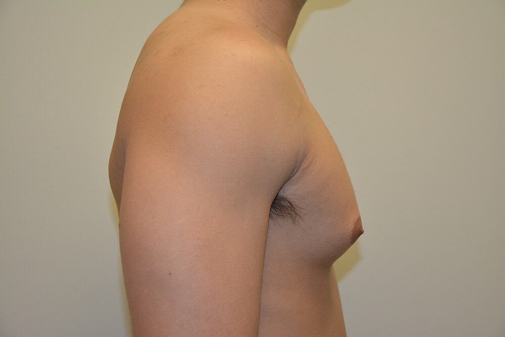 Male-Breast-Reduction-05 | Before Male Breast Reduction 3