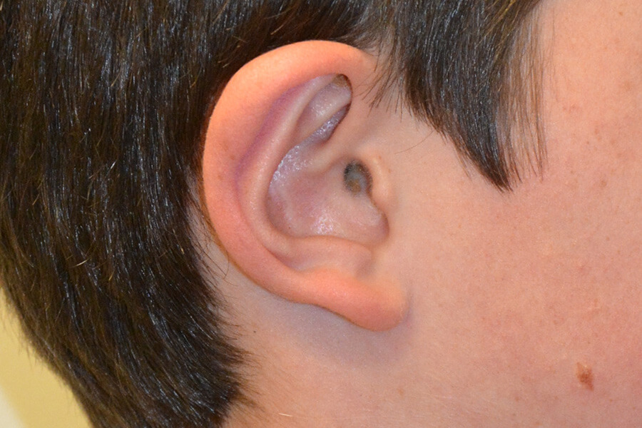 Prominent-Ear-Surgery-06 | After Prominent Ear Surgery 5