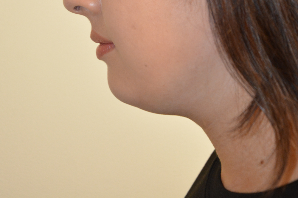 Neck-Liposuction-05 | Before Neck Liposuction 4