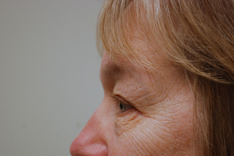 Eyelid-Surgery-06 | Before Eyelid Surgery 3