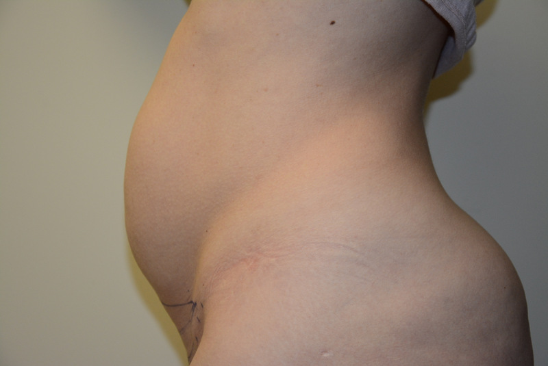 Mini-Tummy-Tuck-05 | Before Mini Tummy Tuck 3