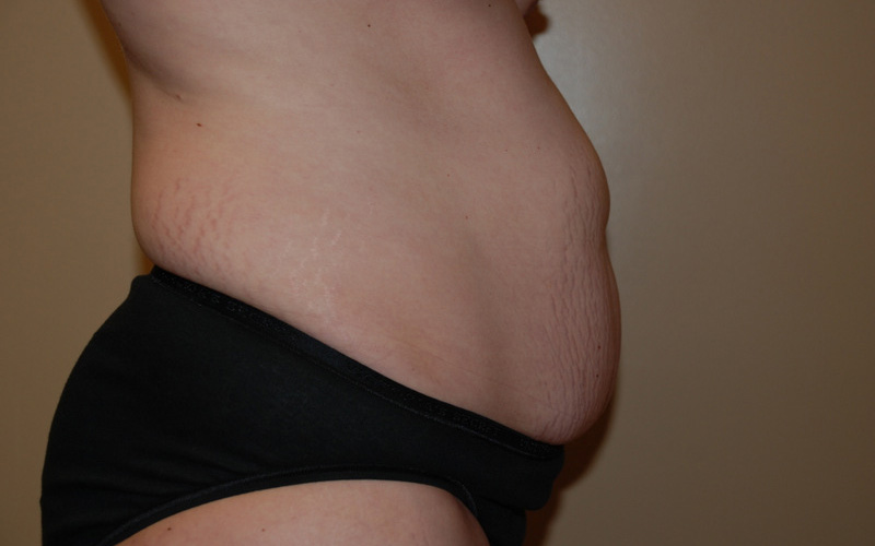 Tummy-Tuck-08 | Before Tummy Tuck 3