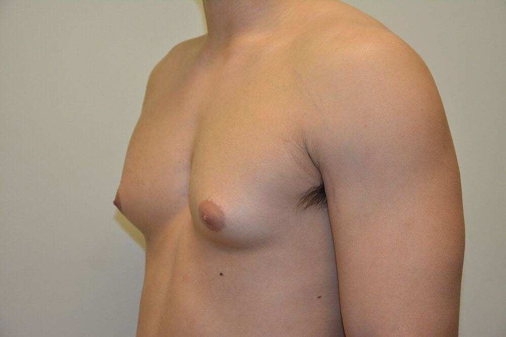 Male-Breast-Reduction-05 | Before Male Breast Reduction 4