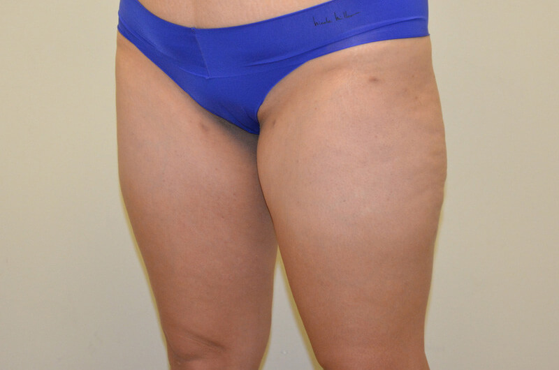 Liposuction-04 | After Liposuction 2