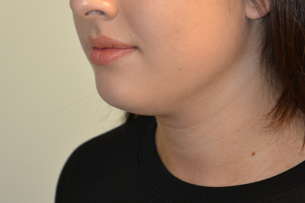 Neck-Liposuction-05 | Before Neck Liposuction 5