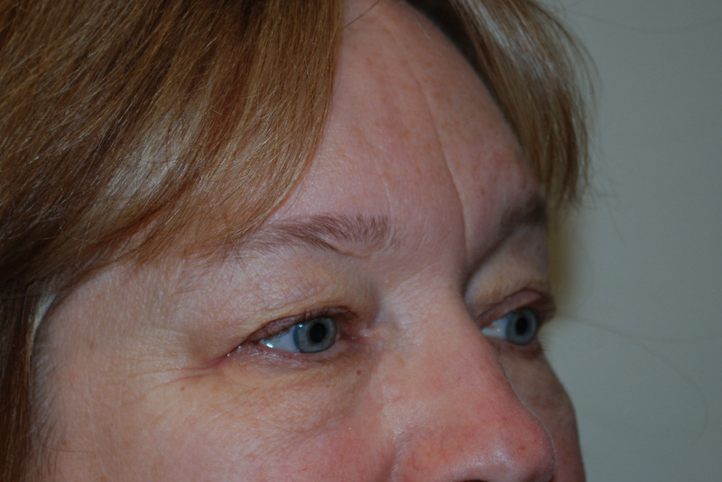 Eyelid-Surgery-06 | Before Eyelid Surgery 4