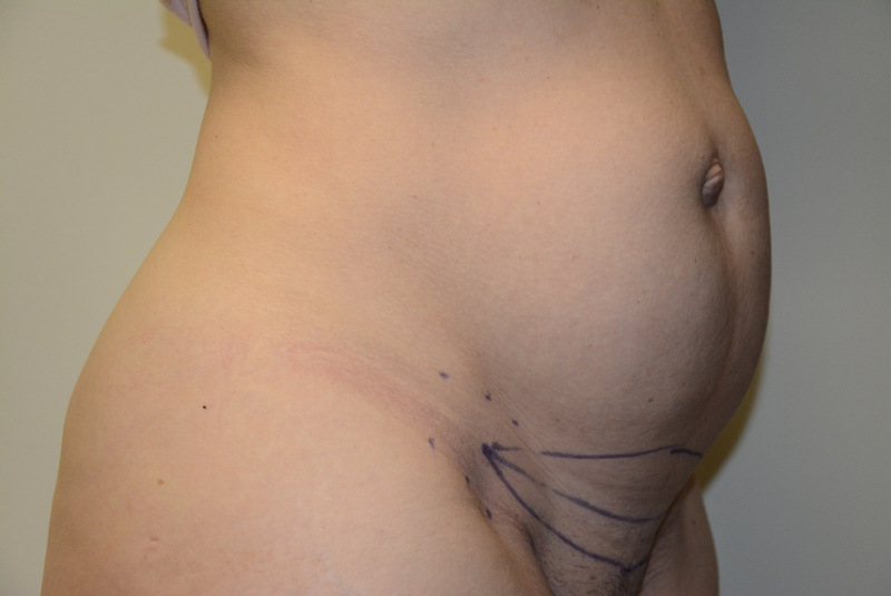 Mini-Tummy-Tuck-05 | Before Mini Tummy Tuck 4