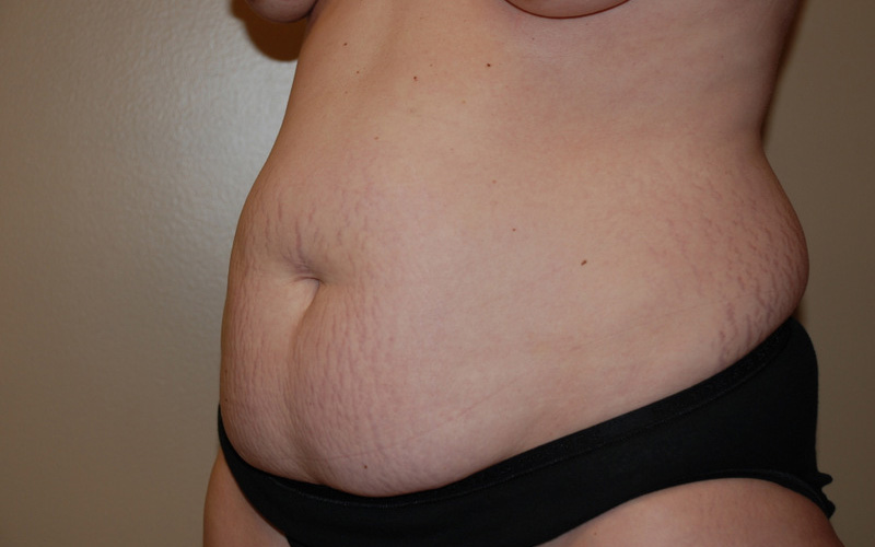 Tummy-Tuck-08 | Before Tummy Tuck 4