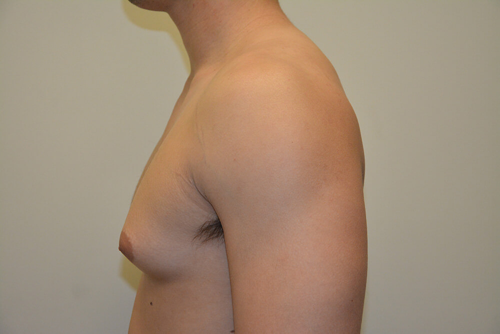Male-Breast-Reduction-05 | Before Male Breast Reduction 5