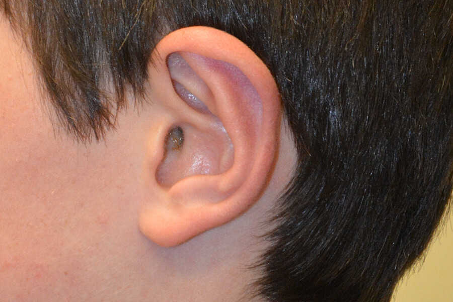 Prominent-Ear-Surgery-06 | After Prominent Ear Surgery 3