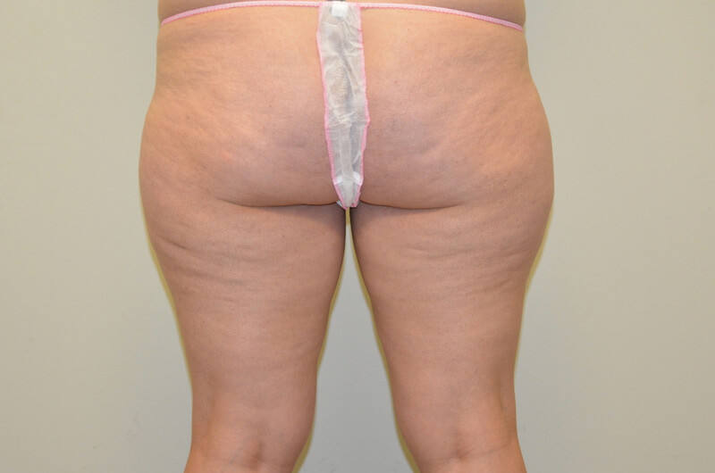 Liposuction-04 | Before Liposuction 3