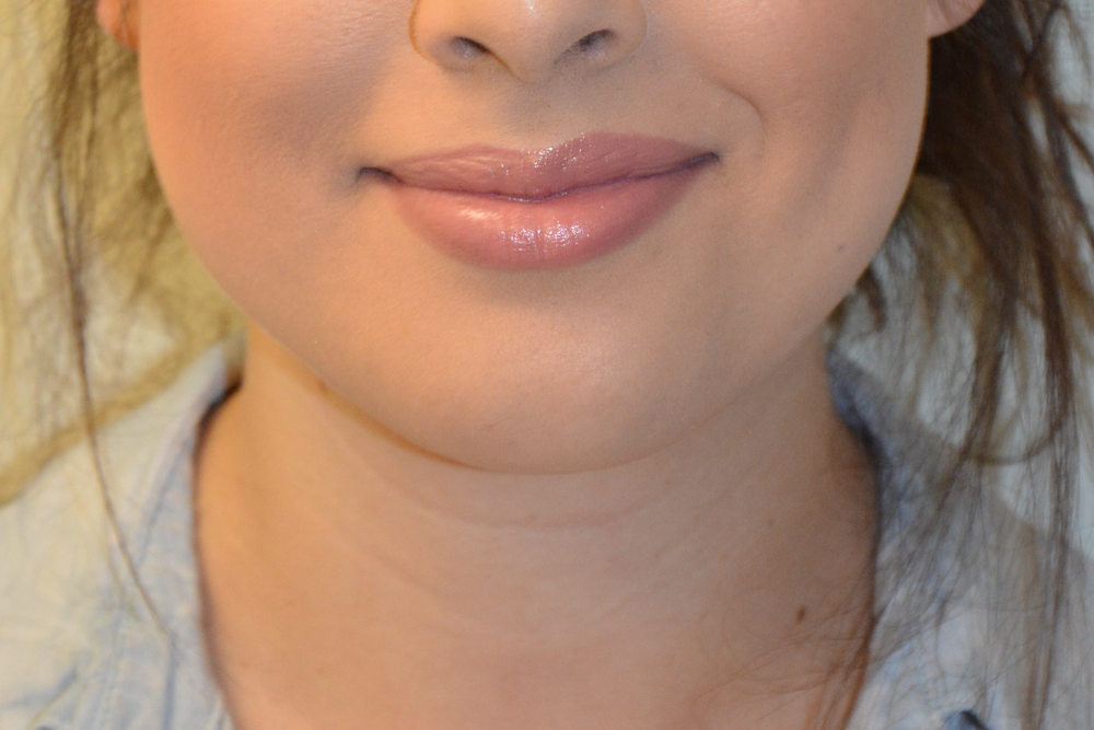 Neck-Liposuction-05 | After Neck Liposuction