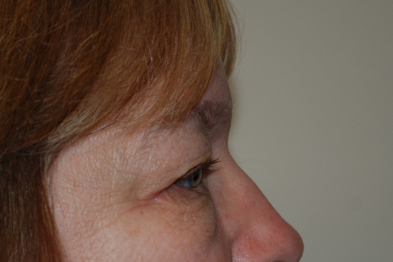 Eyelid-Surgery-06 | Before Eyelid Surgery 5