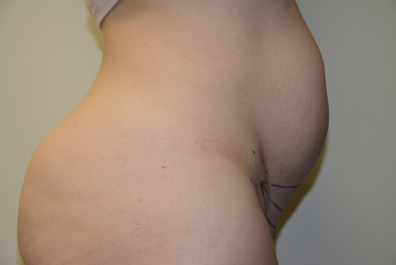 Mini-Tummy-Tuck-05 | Before Mini Tummy Tuck 5