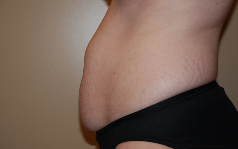 Tummy-Tuck-08 | Before Tummy Tuck 5