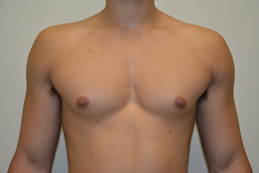 Male-Breast-Reduction-05 | After Male Breast Reduction