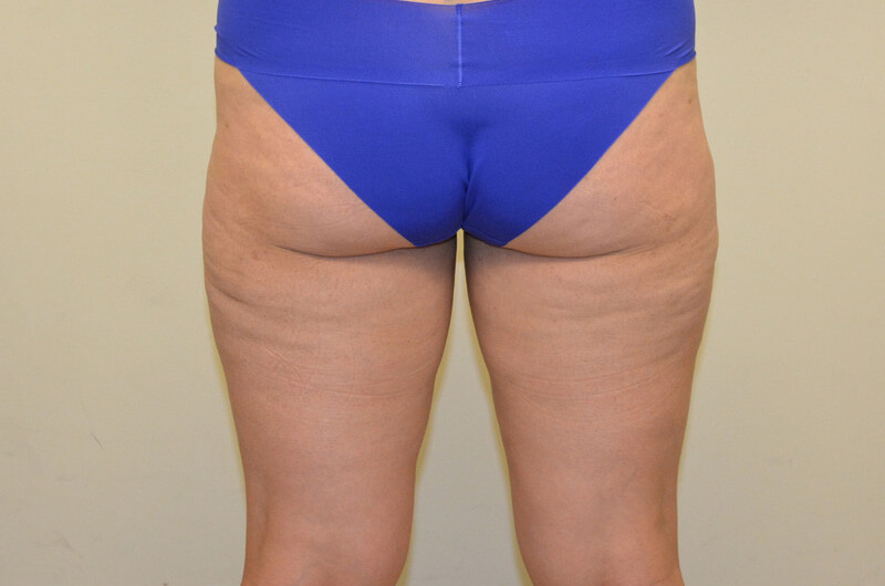 Liposuction-04 | After Liposuction 3