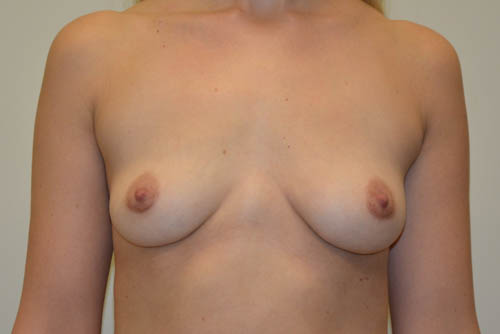 Implant-Removal-05 | After Implant Removal