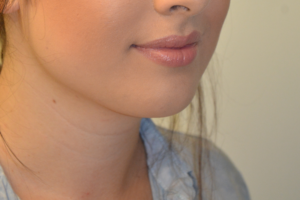 Neck-Liposuction-05 | After Neck Liposuction 2