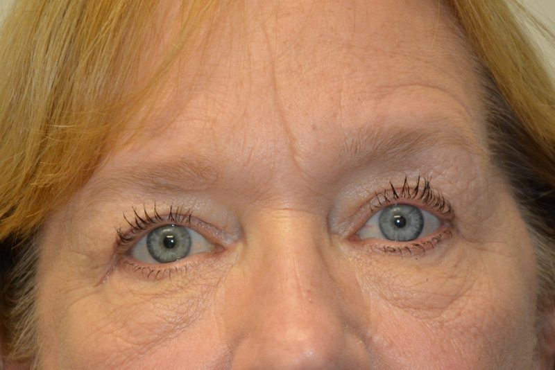 Eyelid-Surgery-06 | After Eyelid Surgery 1