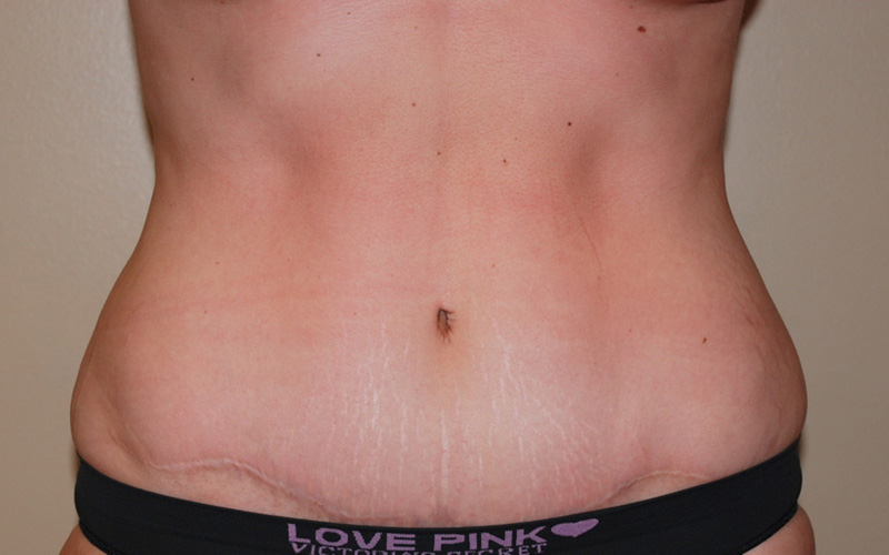 Tummy-Tuck-08 | After Tummy Tuck