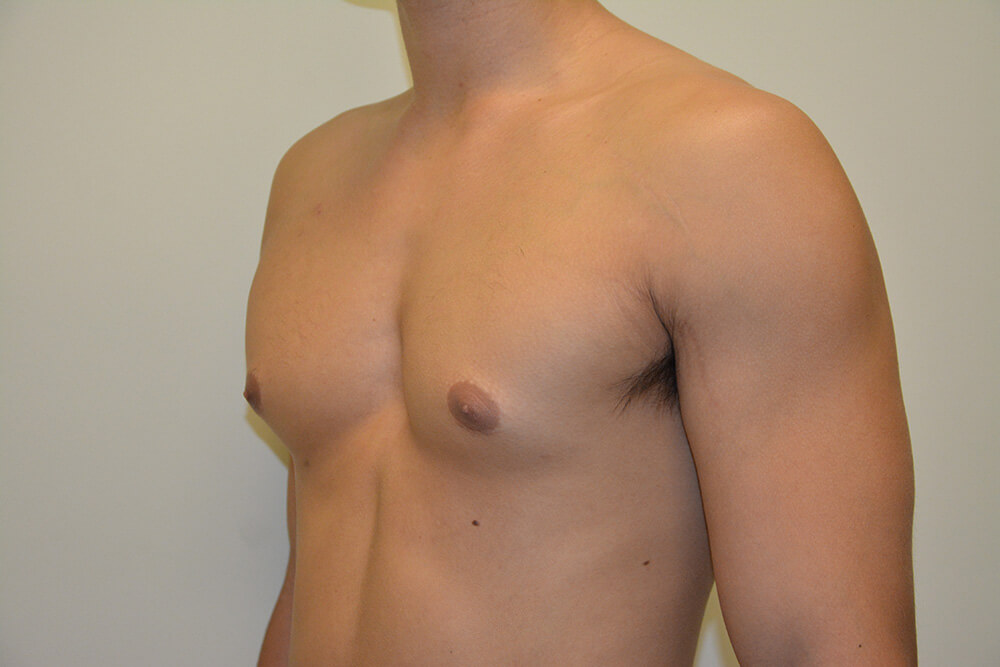 Male-Breast-Reduction-05 | After Male Breast Reduction 4