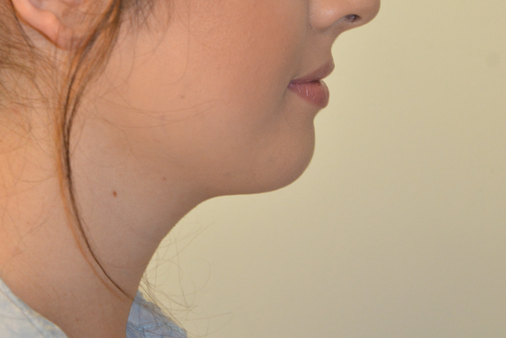 Neck-Liposuction-05 | After Neck Liposuction 3