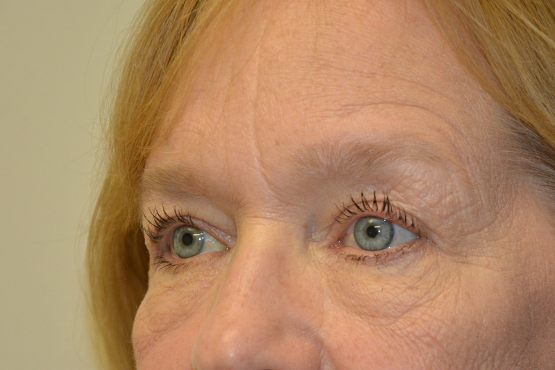 Eyelid-Surgery-06 | After Eyelid Surgery 2