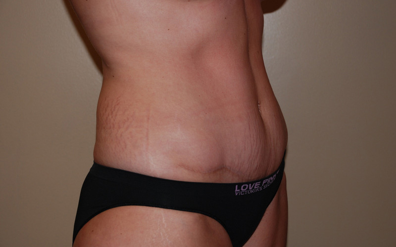 Tummy-Tuck-08 | After Tummy Tuck 2