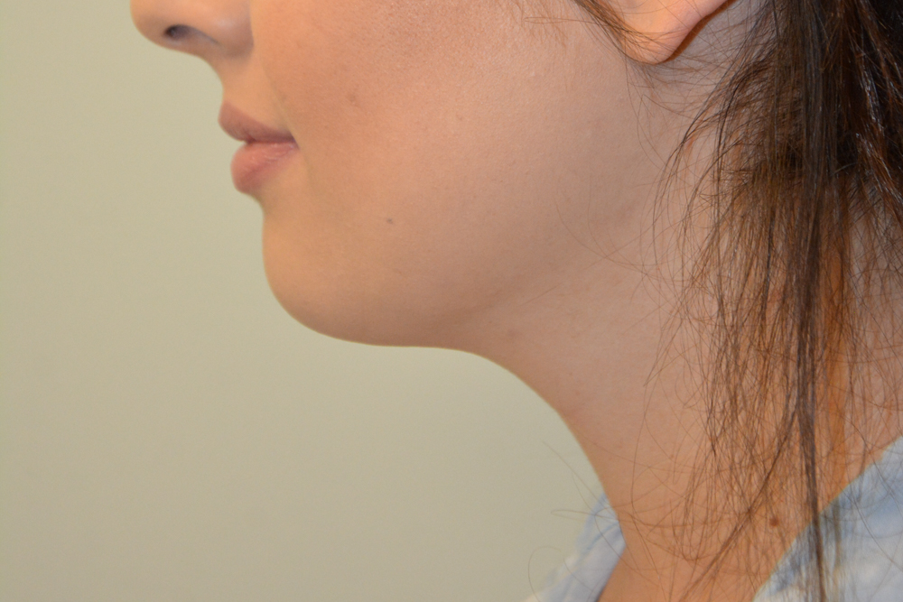 Neck-Liposuction-05 | After Neck Liposuction 4