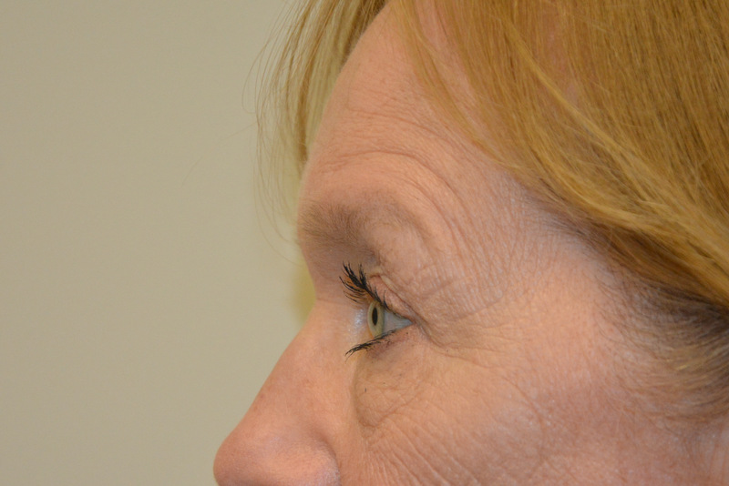 Eyelid-Surgery-06 | After Eyelid Surgery 3