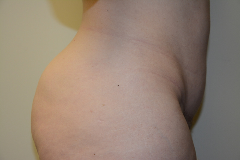 Mini-Tummy-Tuck-05 | After Mini Tummy Tuck 5