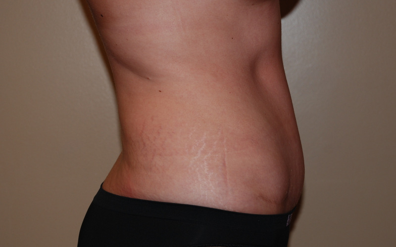 Tummy-Tuck-08 | After Tummy Tuck 3