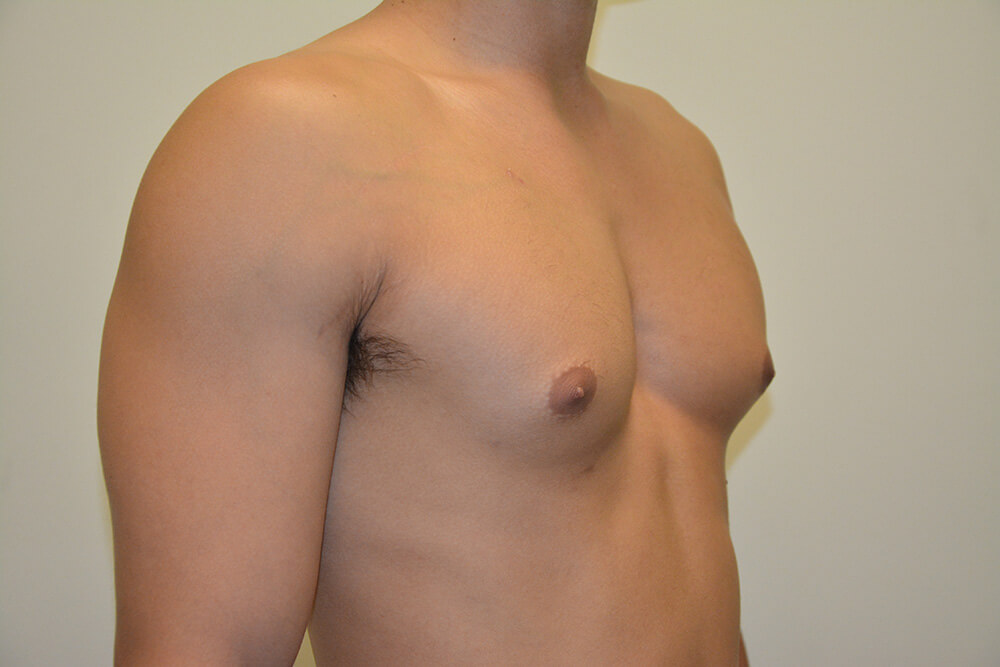 Male-Breast-Reduction-05 | After Male Breast Reduction 2