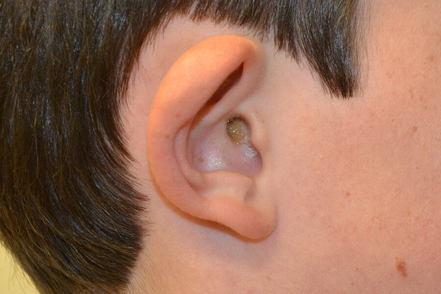Prominent-Ear-Surgery-06 | Before Prominent Ear Surgery 5