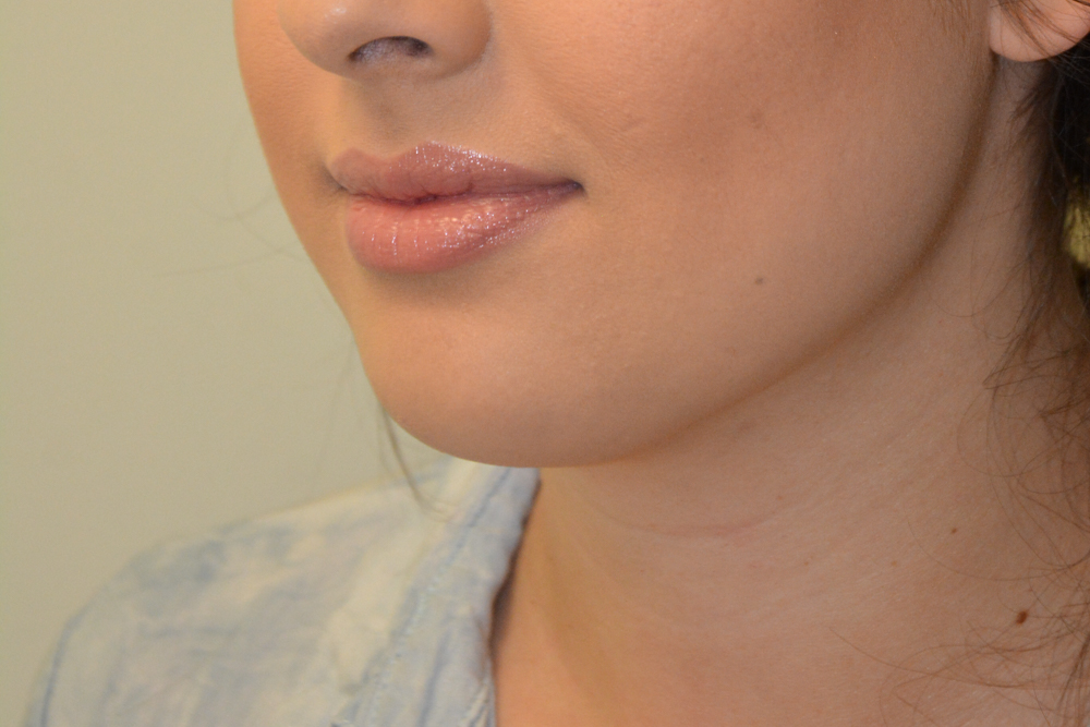 Neck-Liposuction-05 | After Neck Liposuction 5