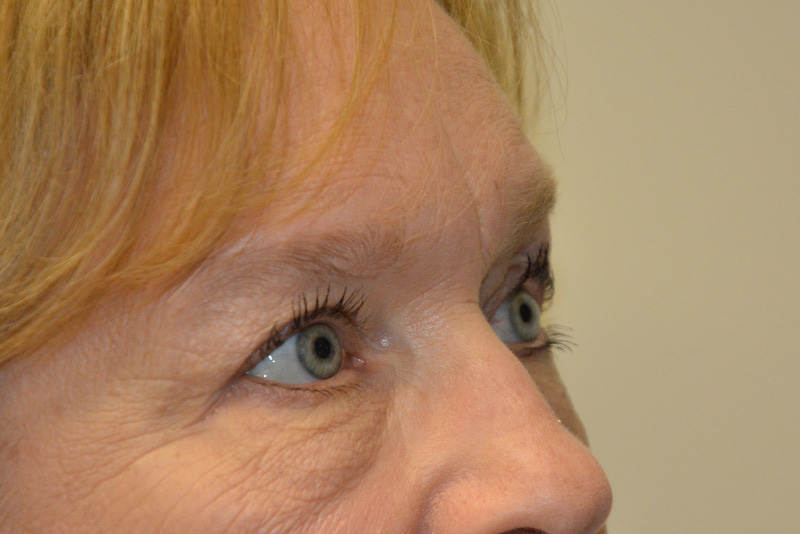 Eyelid-Surgery-06 | After Eyelid Surgery 4