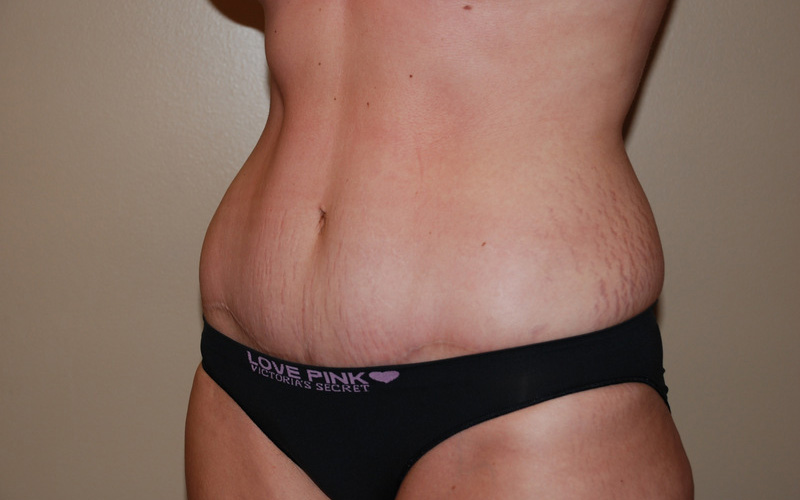 Tummy-Tuck-08 | After Tummy Tuck 4