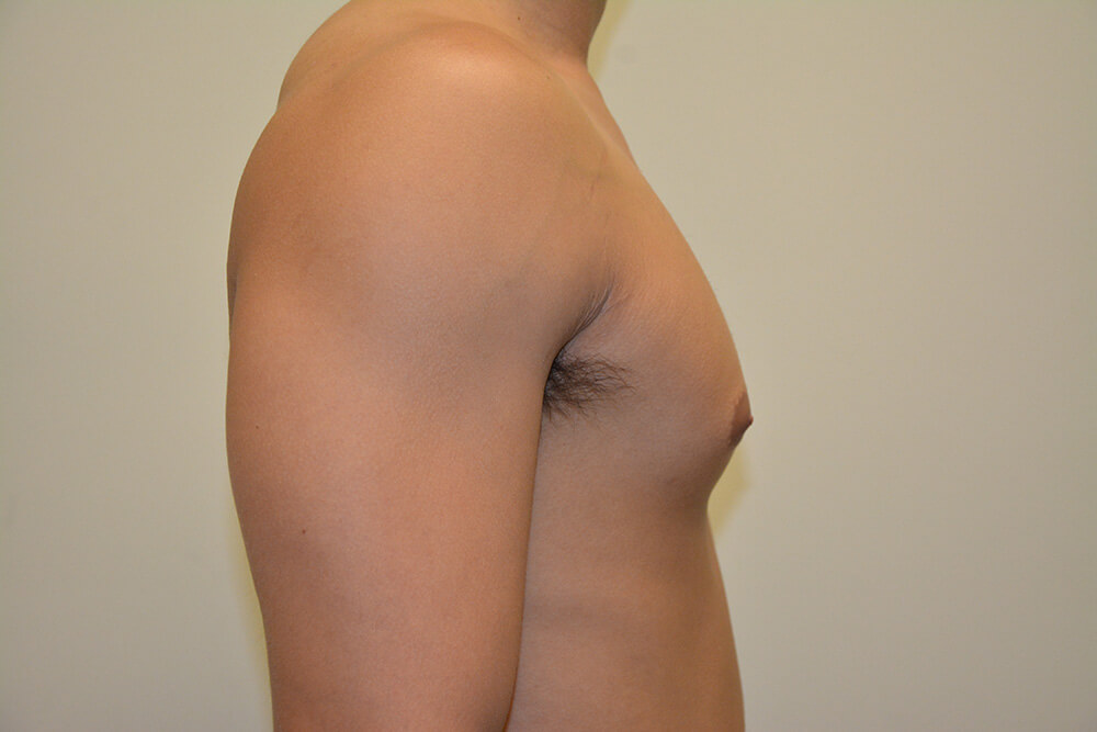 Male-Breast-Reduction-05 | After Male Breast Reduction 3