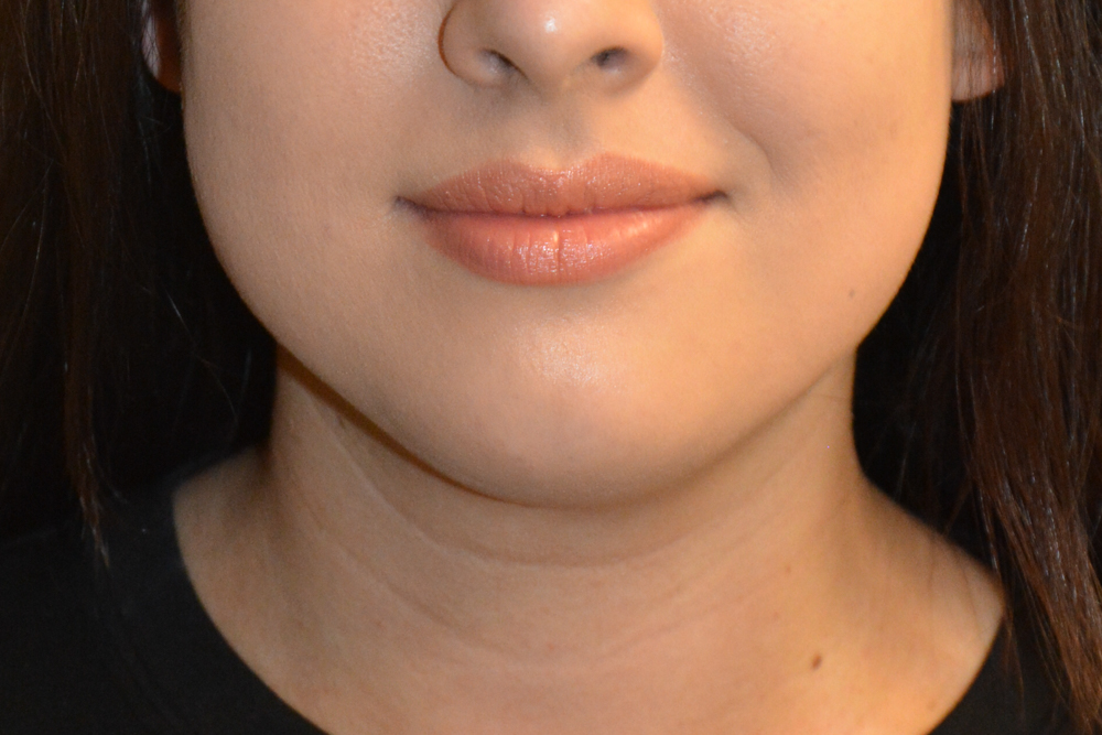 Neck-Liposuction-05 | Before Neck Liposuction